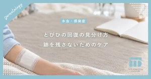 【とびひの治し方まとめ】見分け方のポイントと跡を残さず早く治すステップ