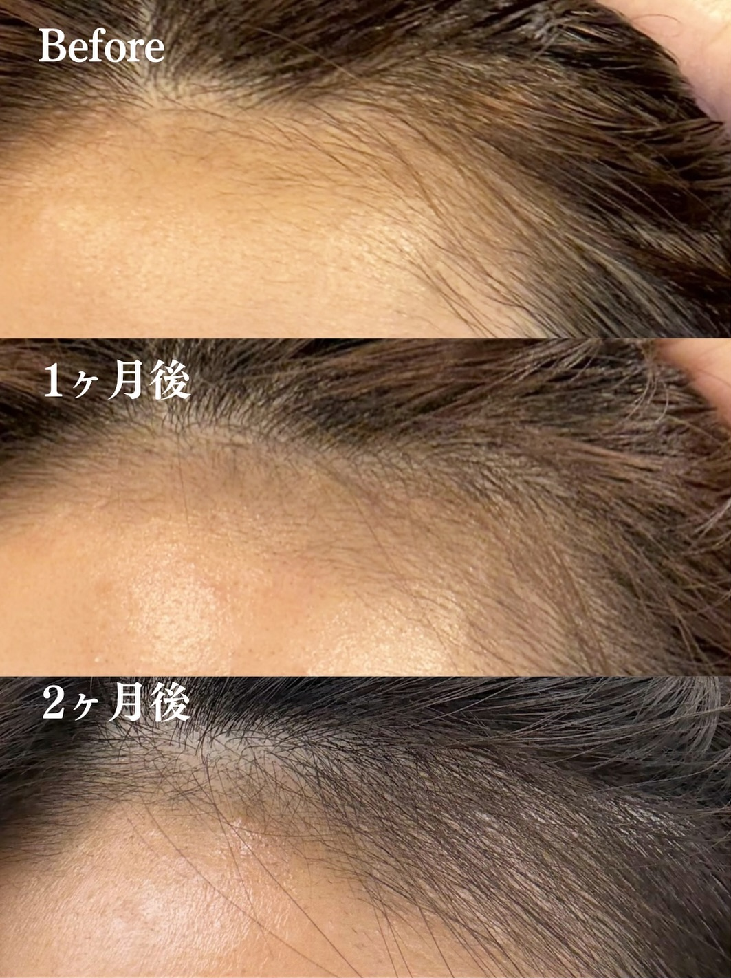 ミノキシジル5％外用による治療（30代女性）の治療経過