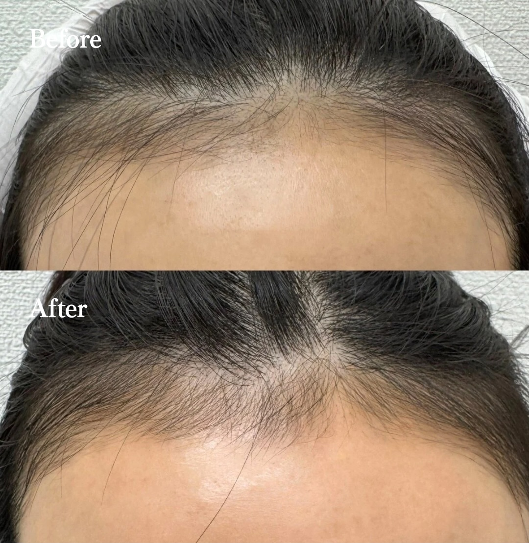 キュアジェット＋MPFによる頭皮治療（30代女性）の治療経過（写真2）