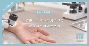 【疥癬トンネルの見つけ方】指の間や手首にできる線の正体と皮膚科での診断