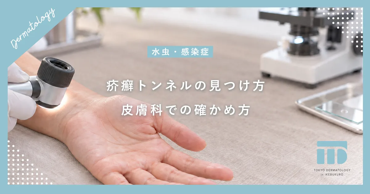 【疥癬トンネルの見つけ方】指の間や手首にできる線の正体と皮膚科での診断