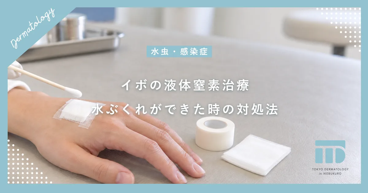 イボの液体窒素治療(凍結療法)とは?効果的なやり方と水ぶくれができた時の対処法